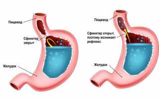 Спазмы вверху желудка