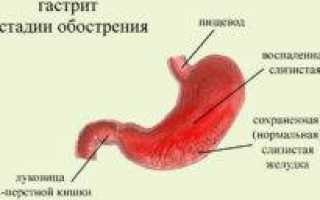 Обострился гастрит что делать