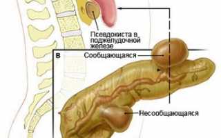 Псевдокиста поджелудочной железы