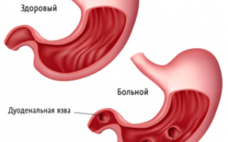 Почему горит желудок причины