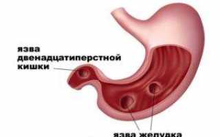 Диета при гастрите и язве двенадцатиперстной кишки