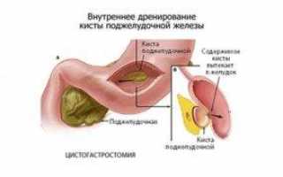 Киста поджелудочной железы