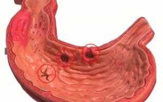 Эрозивный гастродуоденит симптомы и лечение