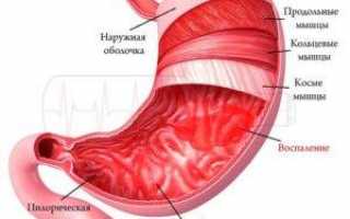 Симптомы, лечение и диета при гастрите