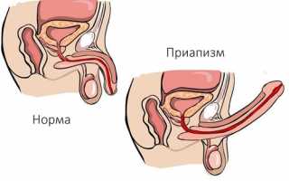 Приапизм у мужчин