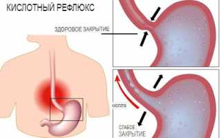 Можно ли кефир при рефлюксе