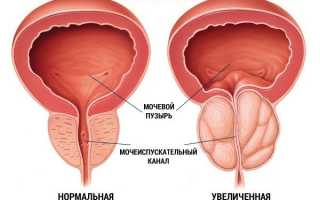 Симптомы простатита у мужчин в его острой и хронической формах