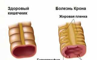 Абсцесс анальной железы