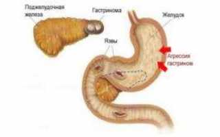 Гастринома симптомы и лечение