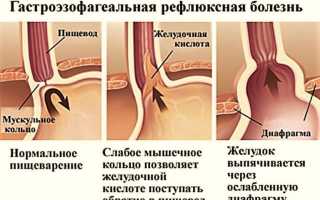 Желудочно-кишечный рефлюкс