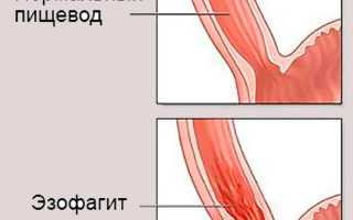 Воспаление пищевода