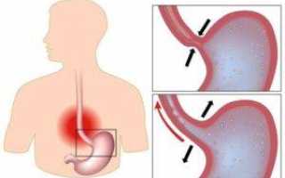 Диета при рефлюкс гастрите желудка