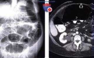 Синдром Огилви (острая псевдообструкция толстой кишки)