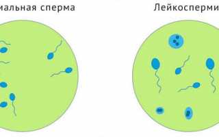 Лейкоспермия у мужчин