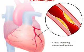 Хроническая изжога