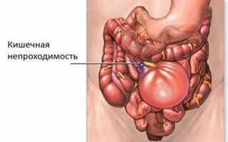 Частичная и полная непроходимость кишечника