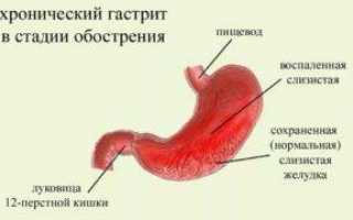 Клинические рекомендации при гастрите