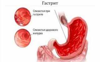 Изменение слизистой желудка