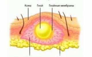 Дивертикулит симптомы и признаки