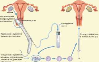 Как происходит пункция яичников при процедуре ЭКО