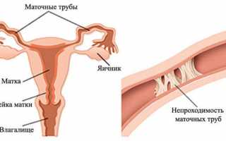 Непроходимость маточных труб и беременность
