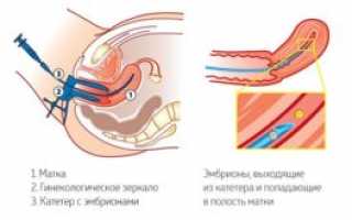 Больно ли делать перенос эмбрионов при ЭКО?