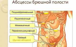 Внутрибрюшной абсцесс