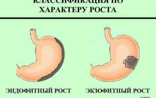 Рост желудка доброкачественный и злокачественный