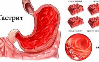 Раздражение желудка симптомы и причины