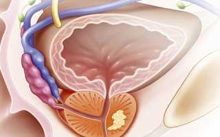 Фиброз простаты