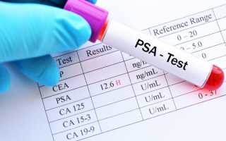 Все об анализе крови на ПСА у мужчин