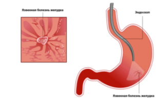 Признаки язвы желудка симптомы у ребенка