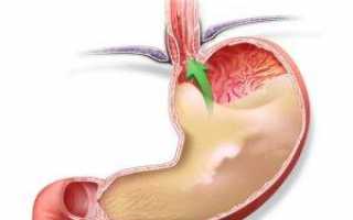 Как бороться с изжогой при гастрите