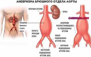 Аневризма аорты в желудке