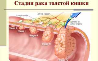 Рак толстой и прямой кишки — скрининг, диагностика, стадии