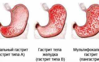 Гастрит у ребенка 7 лет