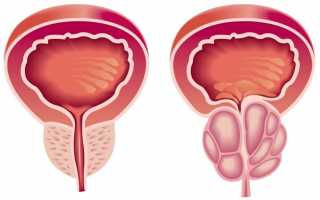 Гиперплазия предстательной железы