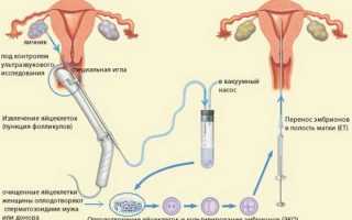 Чем грозит молочница перед пункцией ЭКО?