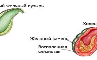 Воспаление желчного пузыря