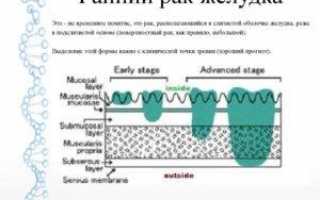 Ранние стадии рака желудка симптомы