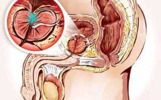 Конгестивный простатит