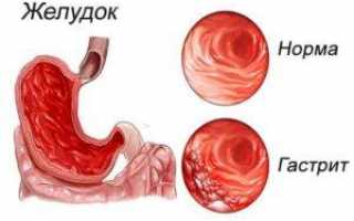 Что такое гипоацидный гастрит