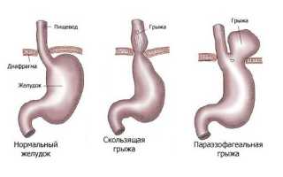 Грыжа желудка симптомы лечение