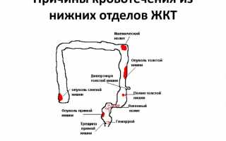 Кровотечение из нижних отделов ЖКТ