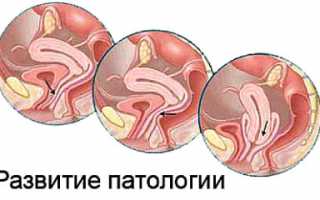 Опущение матки на ранних и поздних сроках при беременности почему опускается и можно ли рожать