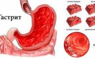 Спазмы желудка причины и лечение
